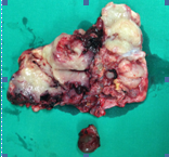 Opened specimen of right oophorectomy (Courtesy Dr. V. Penopoulos)