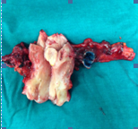 Total hysterectomy specimen (Courtesy Dr. V. Penopoulos)
