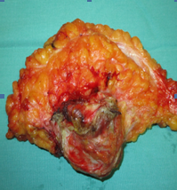 Resected nodule of the right iliac fossa (Courtesy Dr. V. Penopoulos)