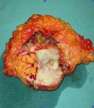 Resected nodule of the right iliac fossa (Courtesy Dr. V. Penopoulos)