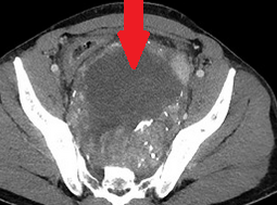 Surgical specimen. Complete resection of the tumor together with a segment of rectum (Courtesy Dr. V. Penopoulos)