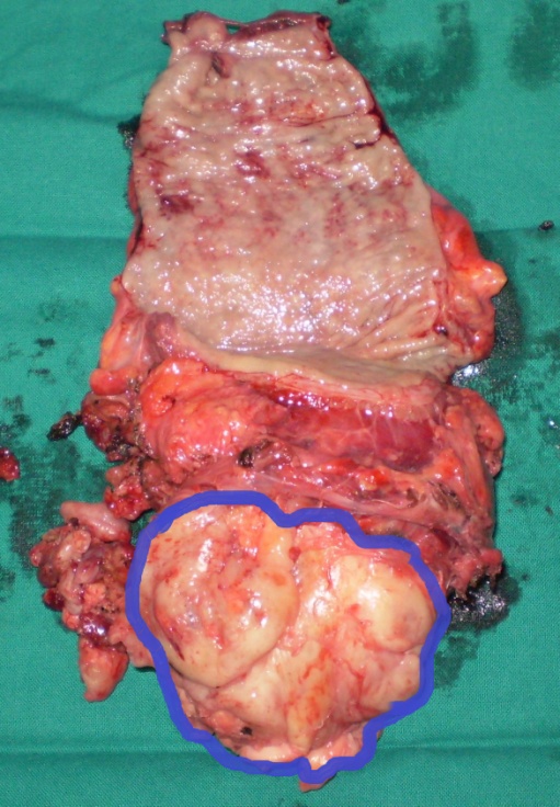Surgical specimen. Complete resection of the tumor together with a segment of rectum (Courtesy Dr. V. Penopoulos)