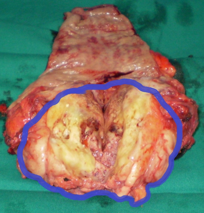 Surgical specimen. Complete resection of the tumor together with a segment of rectum (Courtesy Dr. V. Penopoulos)