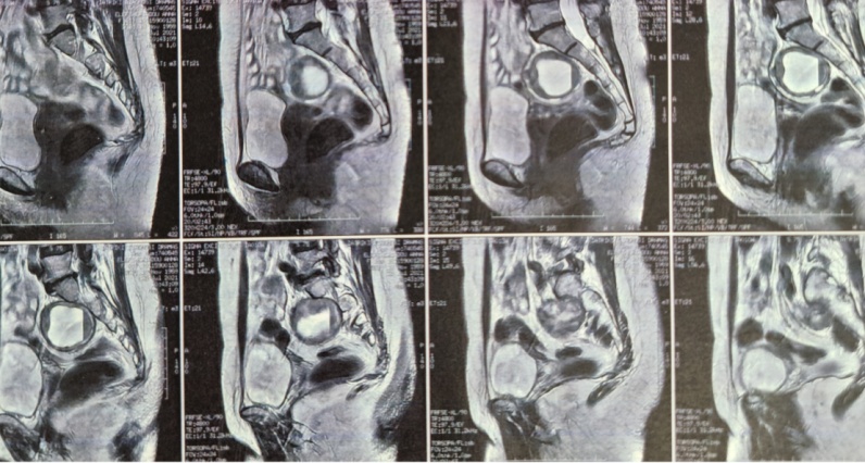 After opening of the specimen, the peripheral solid component and the central cystic component are demonstrated (blue arrow) (Courtesy Dr. V. Penopoulos)