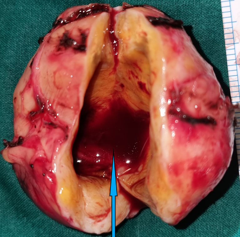 Characteristic Antoni A and Antoni B areas, indicative of a benign schwannoma (Courtesy Dr. V. Penopoulos)