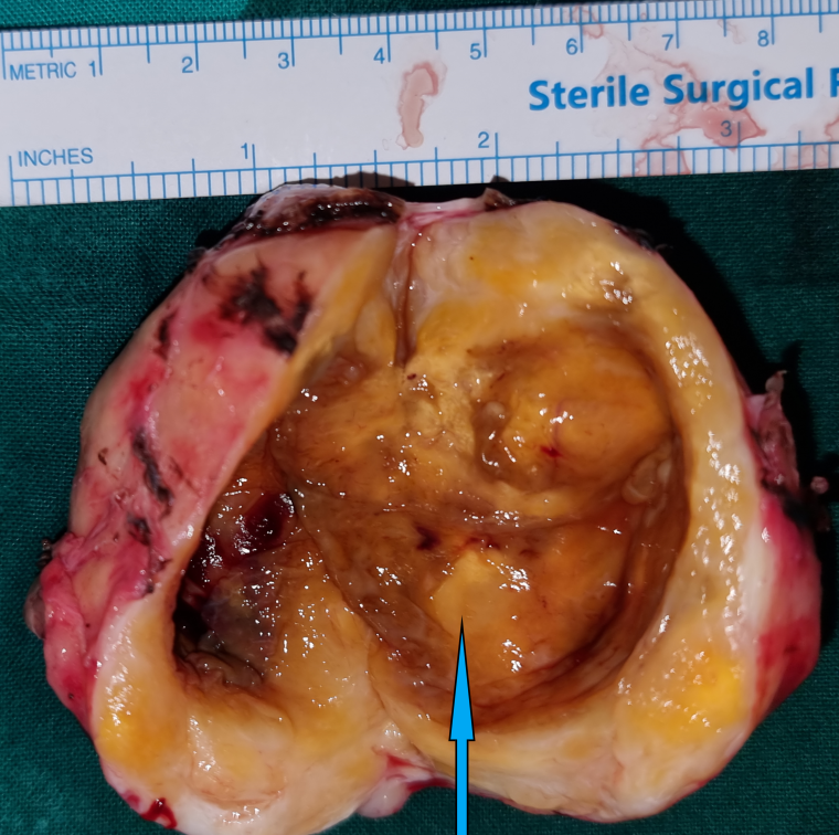 Characteristic Antoni A and Antoni B areas, indicative of a benign schwannoma (Courtesy Dr. V. Penopoulos)
