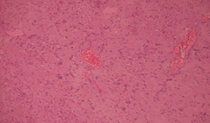Characteristic Antoni A and Antoni B areas, indicative of a benign schwannoma (Courtesy Dr. V. Penopoulos)