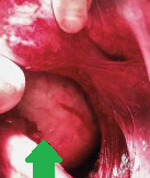 The epidermoid cyst in the pelvis, after its exposure (Courtesy Dr. V. Penopoulos)