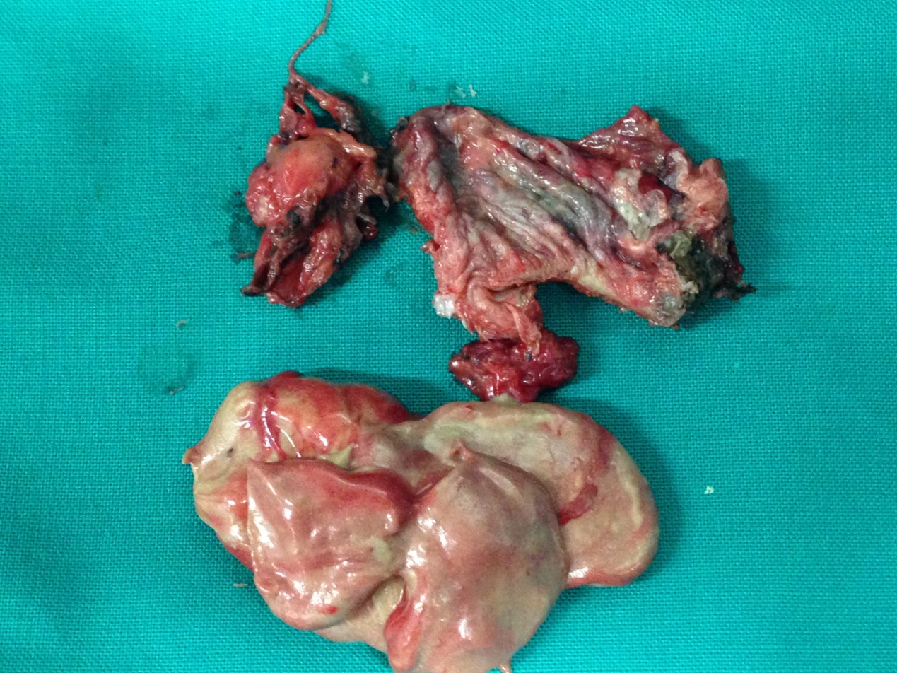 Excised epidermoid cyst and part of its contents (Courtesy Dr. V. Penopoulos)