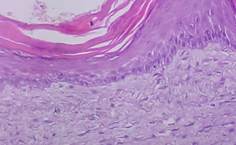 Histological image. Presence of stratified squamous epithelium without finding of skin adnexal structures (Courtesy Dr. V. Penopoulos)