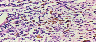 a) Presence of numerous macrophages containing hemosiderin, cholesterol clefts, intermixed with inflammatory cells and cellular debris. b) Presence of a fibrocollagenous capsule and intraluminal necrosis (Courtesy Dr. V. Penopoulos)