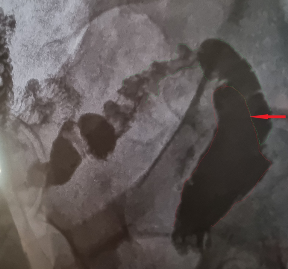 Μετεγχειρητική απεικόνιση ειλεορθικής αναστόμωσης (τροποποιημένη Duhamel). Εμφανής η αναστόμωση του τερματικού ειλεού στο πρόσθιο τοίχωμα του εναπομένοντος κολοβώματος ορθού (Ευγενική παραχώρηση Dr. V. Penopoulos)