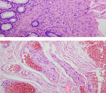 Παρασκεύασμα ορθοσιγμοειδεκτομής (Ευγενική παραχώρηση Dr. V. Penopoulos)