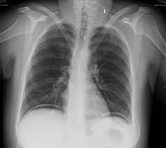 Ελεύθερος υποδιαφραγματικός αέρας (Ευγενική παραχώρηση Dr. V. Penopoulos)