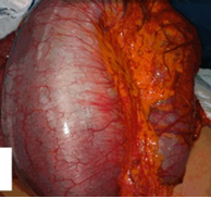 Διερευνητική λαπαροτομία. Έντονη διάταση του κόλου (Ευγενική παραχώρηση Dr. V. Penopoulos)