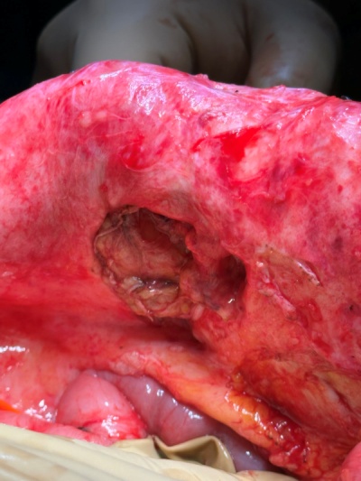 Τομιαία κήλη (Ευγενική παραχώρηση Dr. V. Penopoulos)