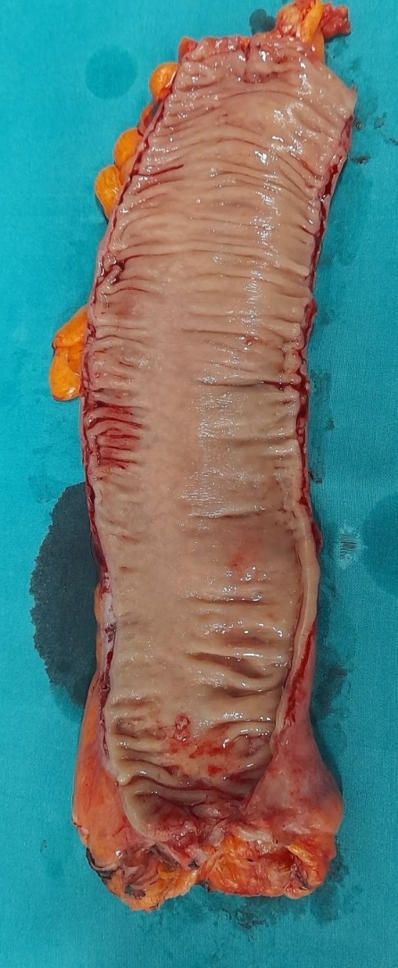 Εσωτερική κήλη (Ευγενική παραχώρηση Dr. V. Penopoulos)