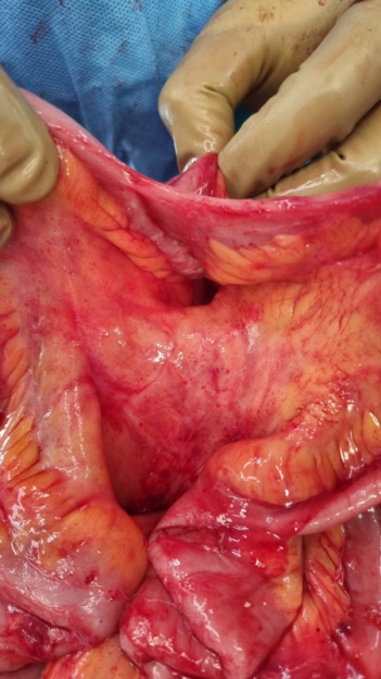 Παρασκεύασμα ολικής κολεκτομής. Κόκκινο βέλος: προηγούμενη κολοκολική αναστόμωση (Ευγενική παραχώρηση Dr. V. Penopoulos)