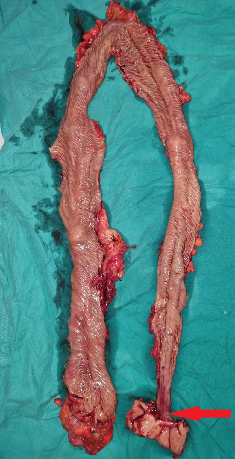 Παρασκεύασμα ολικής κολεκτομής. Κόκκινο βέλος: προηγούμενη κολοκολική αναστόμωση (Ευγενική παραχώρηση Dr. V. Penopoulos)