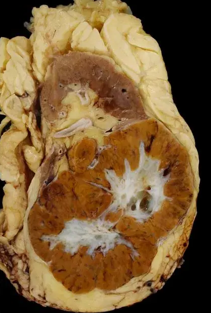 Renal oncocytoma with the characteristic central stellate scar of the neoplasm (Courtesy Dr. V. Penopoulos)