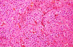 Oncocytoma, with a solid growth pattern, composed of polygonal cells, with dense granular eosinophilic cytoplasm (Courtesy Dr. V. Penopoulos)