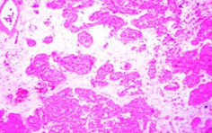 Demonstration of oncocytoma within a stroma of loose, paucicellular connective tissue (Courtesy Dr. V. Penopoulos)