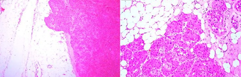 Oncocytoma with evident perinephric fat invasion (Courtesy Dr. V. Penopoulos)