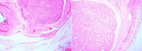 Oncocytoma with evident vascular invasion (Courtesy Dr. V. Penopoulos)