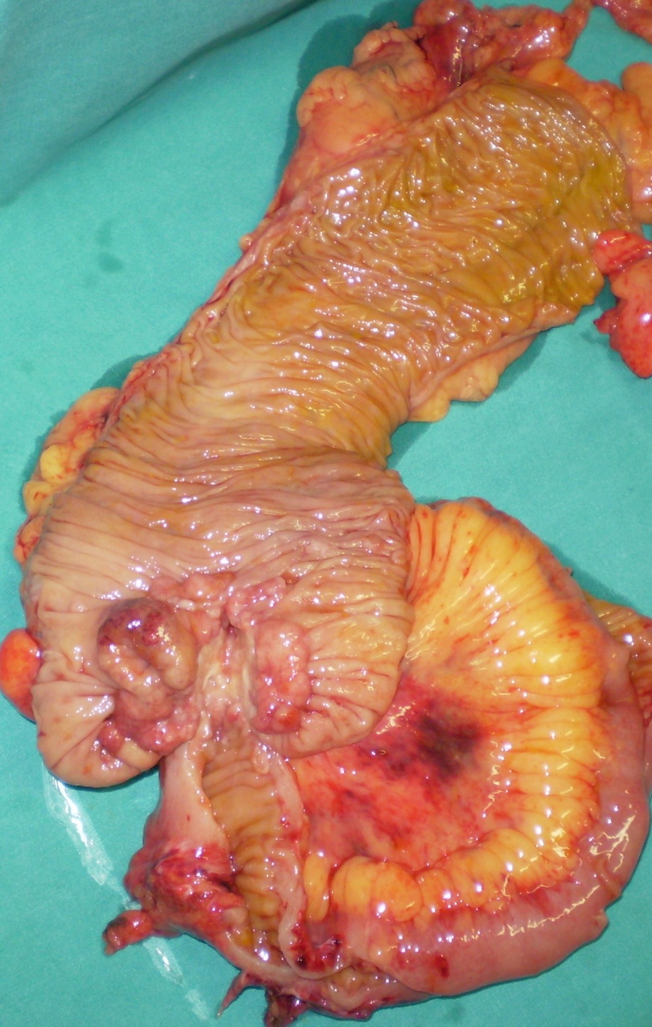 Παρασκεύασμα δεξιάς ημικολεκτομής. Το νεόπλασμα του τυφλού είναι σαφώς ορατό (Ευγενική παραχώρηση Dr. V. Penopoulos).