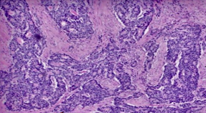 Διηθητικό NET τυφλού (Ευγενική παραχώρηση Dr. V. Penopoulos).