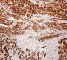 Ανοσοϊστοχημική εξέταση. Θετικότητα για Χρωμογρανίνη Β (Ευγενική παραχώρηση Dr. V. Penopoulos).