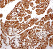 Ανοσοϊστοχημική εξέταση. Θετικότητα για Συναπτοφυσίνη (Ευγενική παραχώρηση Dr. V. Penopoulos).