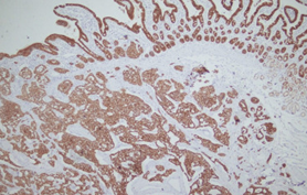 Diffuse positivity for synaptophysin (Courtesy Dr. V. Penopoulos)