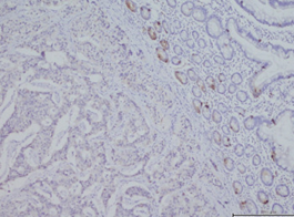 Diffuse positivity for synaptophysin (Courtesy Dr. V. Penopoulos)