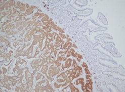 Diffuse positivity for synaptophysin (Courtesy Dr. V. Penopoulos)