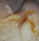 Enlarged, ulcerated ampulla of Vater (Courtesy Dr. V. Penopoulos)