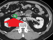 Abdominal computed tomography. Red arrows — neoplasm of the ampulla of Vater (Courtesy Dr. V. Penopoulos)