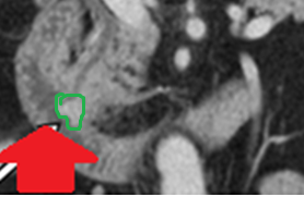 Abdominal computed tomography. Red arrows — neoplasm of the ampulla of Vater (Courtesy Dr. V. Penopoulos)