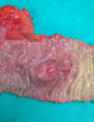 Focal positivity for chromogranin (Courtesy Dr. V. Penopoulos)