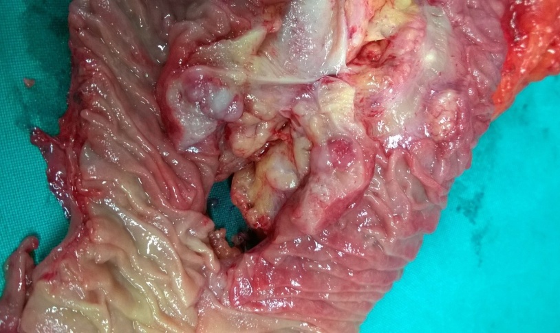 Diffuse positivity for synaptophysin (Courtesy Dr. V. Penopoulos)