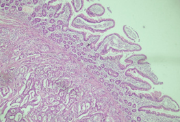 Diffuse positivity for synaptophysin (Courtesy Dr. V. Penopoulos)