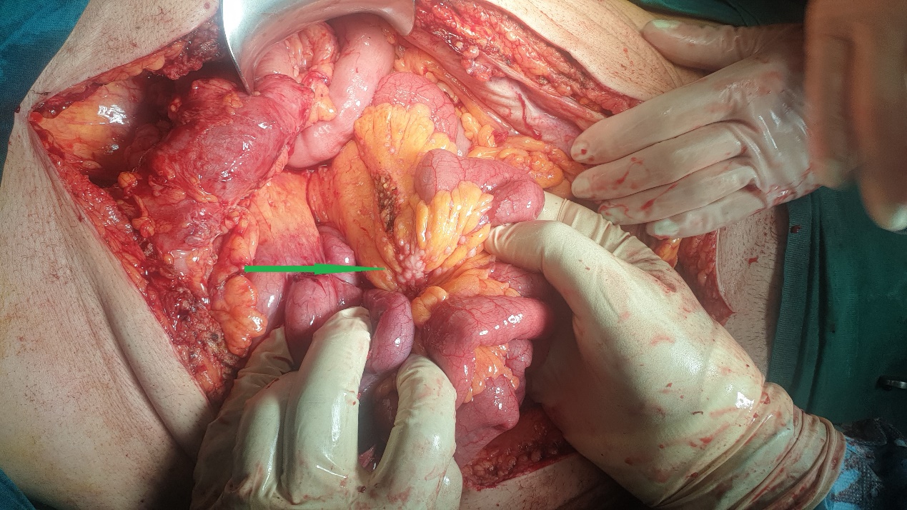 Excision of a metastatic implant for histopathological examination (Courtesy Dr. V. Penopoulos)