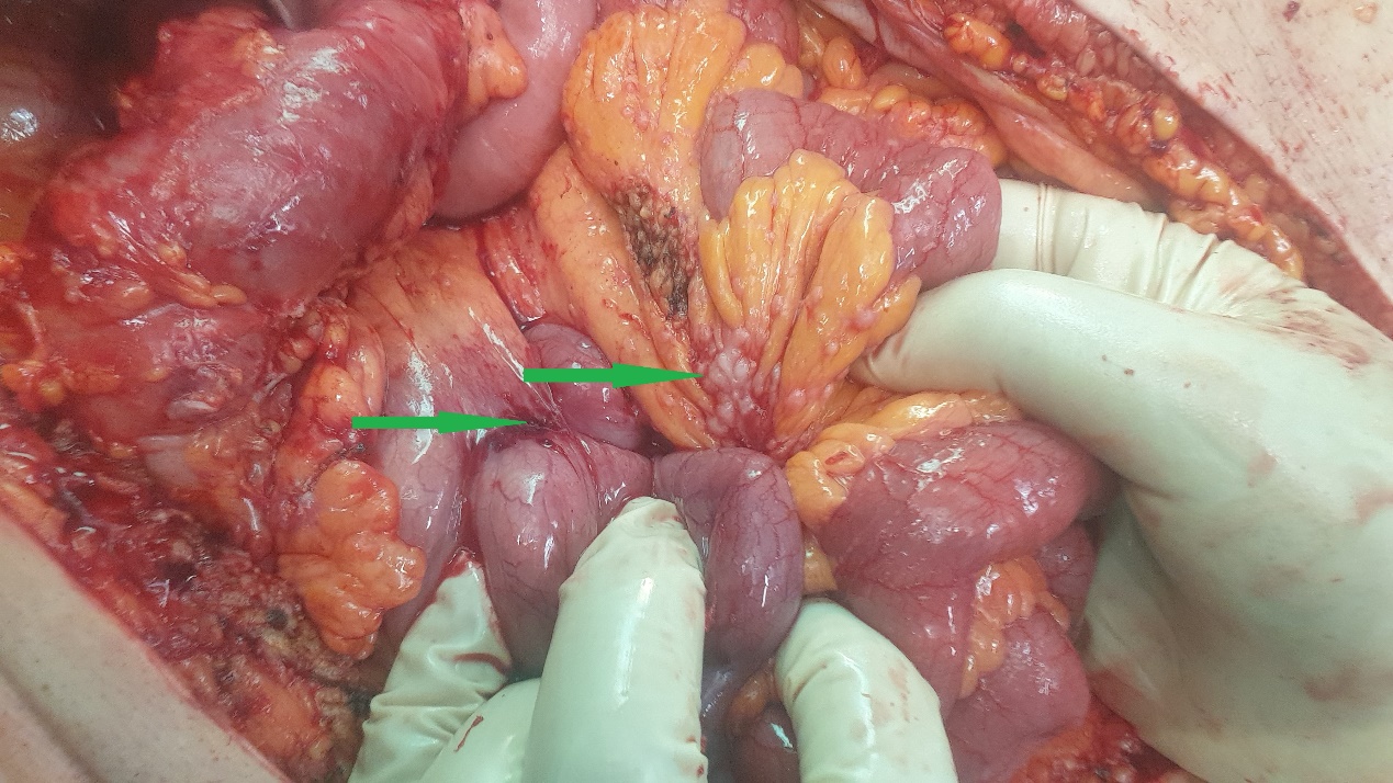 Excision of a metastatic implant for histopathological examination (Courtesy Dr. V. Penopoulos)