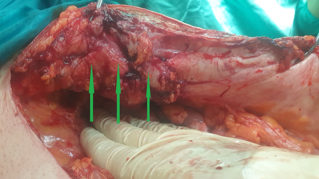 Excision of a metastatic implant for histopathological examination (Courtesy Dr. V. Penopoulos)