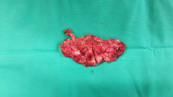 Excision of a metastatic implant for histopathological examination (Courtesy Dr. V. Penopoulos)