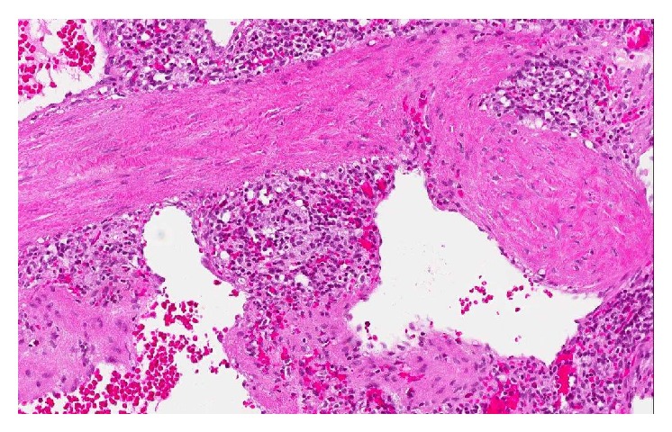 Excision of a metastatic implant for histopathological examination (Courtesy Dr. V. Penopoulos)