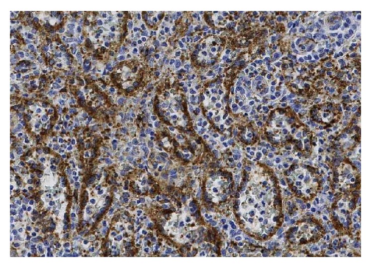 Excision of a metastatic implant for histopathological examination (Courtesy Dr. V. Penopoulos)