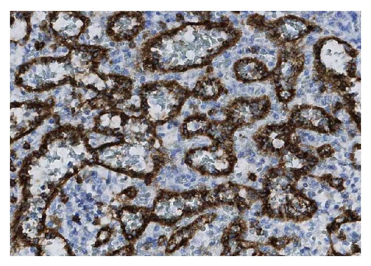 Excision of a metastatic implant for histopathological examination (Courtesy Dr. V. Penopoulos)