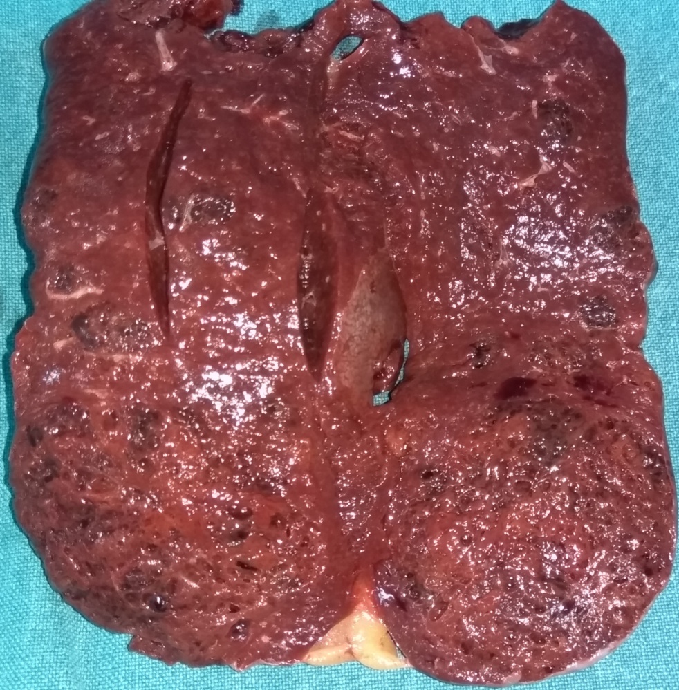 Macroscopic image of the splenectomy specimen. Littoral cell angioma (Courtesy Dr. V. Penopoulos)