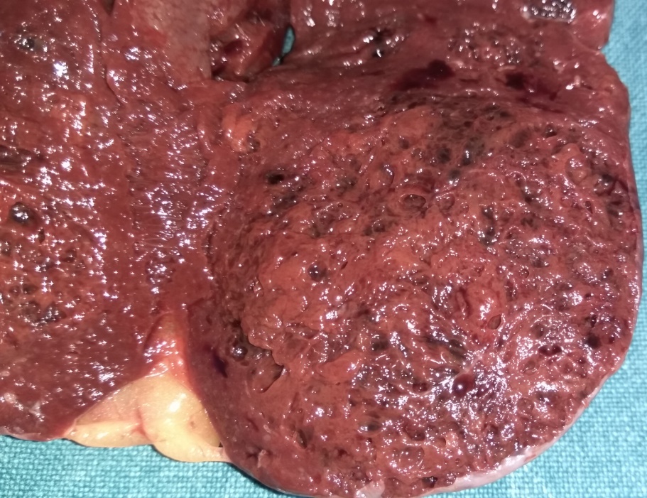 Detail of the littoral cell angioma (Courtesy Dr. V. Penopoulos)